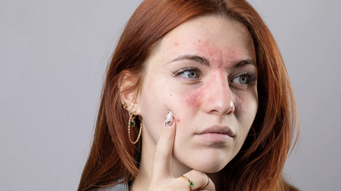 Rosacea Management Near Fairfax, VA: Treatments Explained